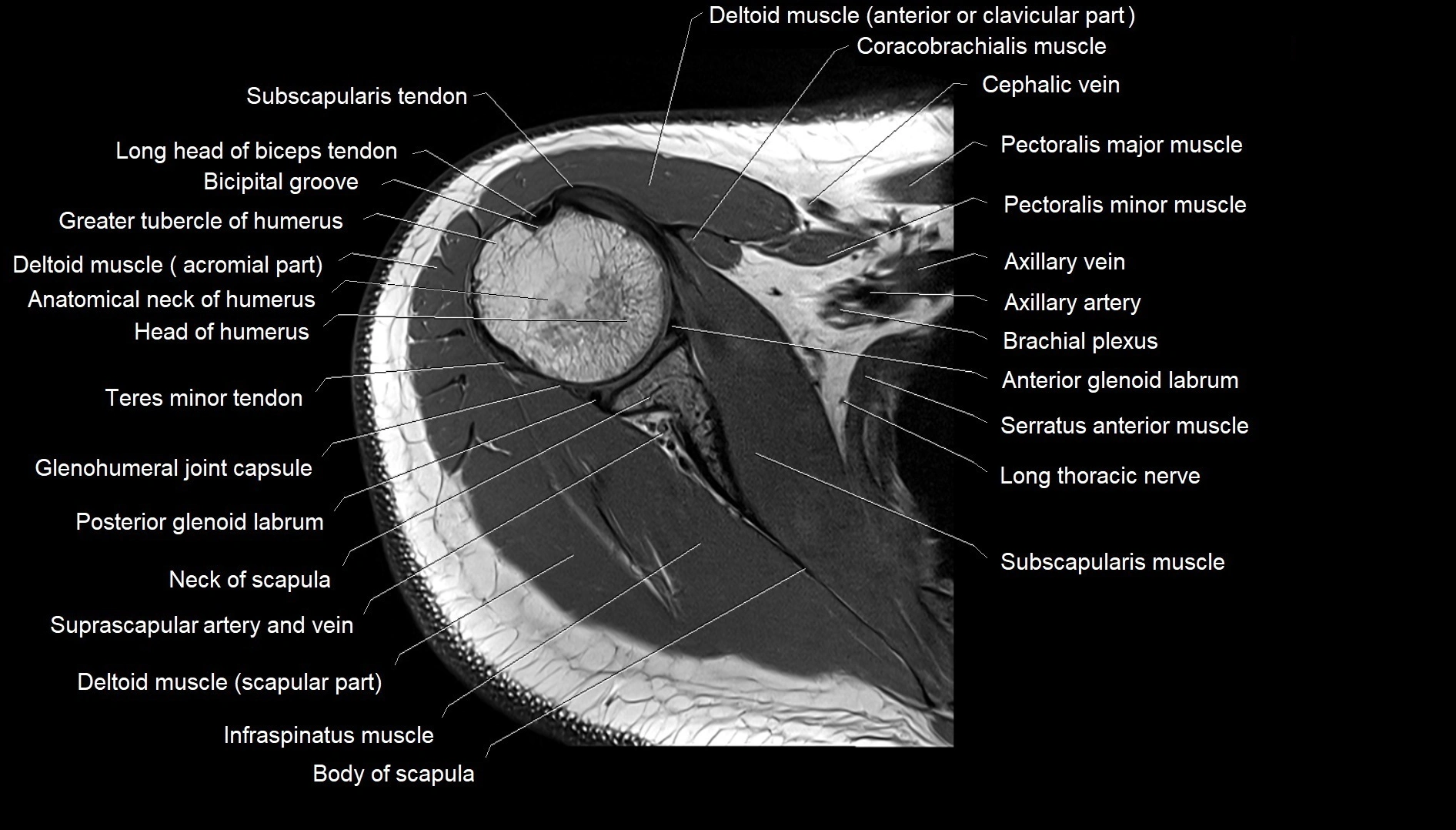 Shoulder cross sectional anatomy MRI 3T axial image 18.webp